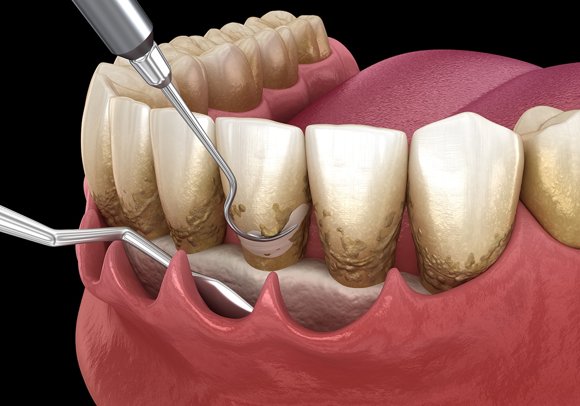 periodontal therapy in brisbane 2